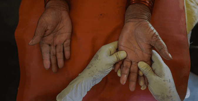 महाराष्ट्र में 2025 में लीपरोसी के नए मामले, बड़े स्क्रीनिंग अभियान से मिली जानकारी